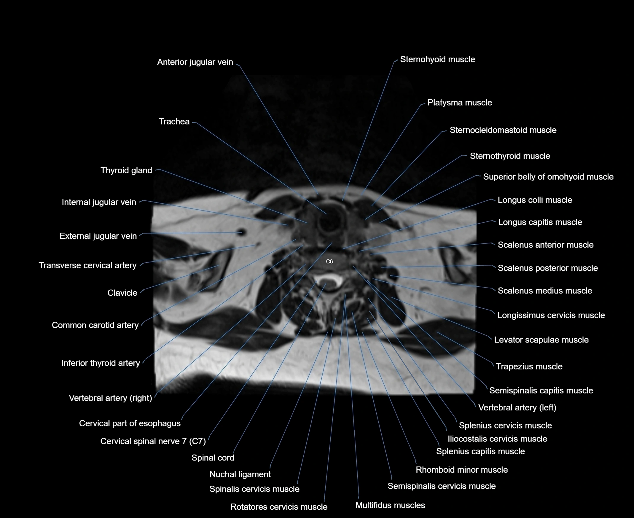 MRI Neck 3D labelled cross section anatomy axial 3t image-00001-00069.webp